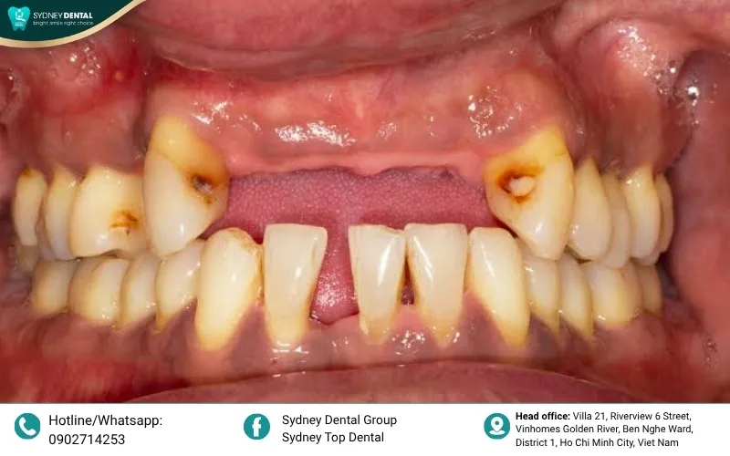 The progression of bone loss from healthy tissue to advanced periodontitis.