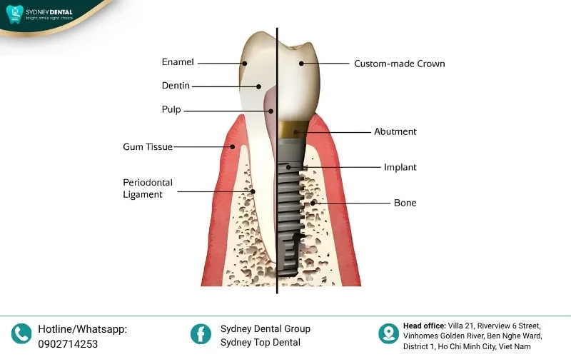 While nutrition improves bone density, surgical intervention is required to restore lost bone volume.