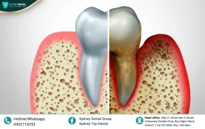 Natural Ways to Reverse Dental Bone Loss: Facts and Optimal Solutions
