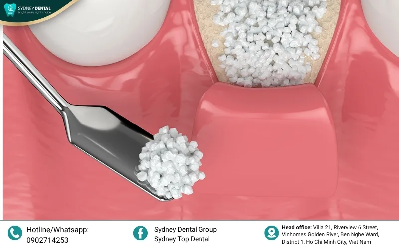 Bone grafting creates a scaffold to stimulate the body's natural bone regrowth process.
