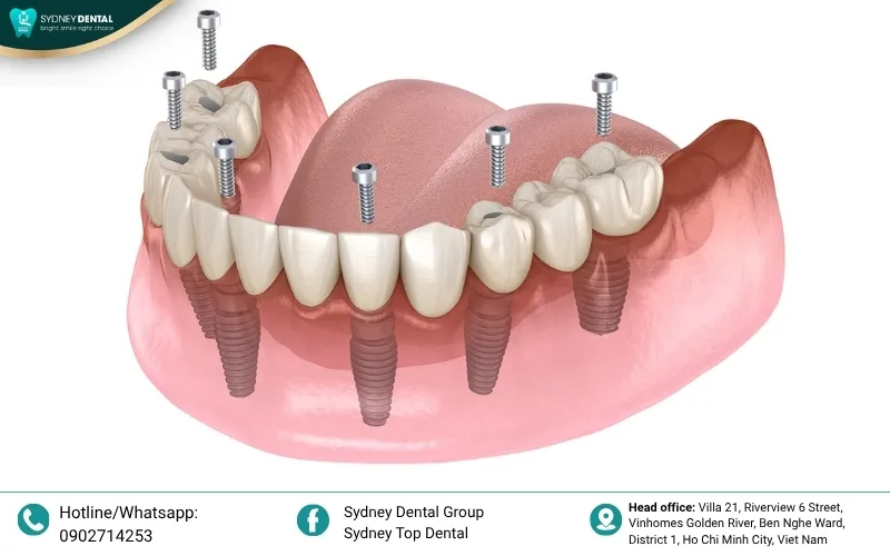 Dental implants are the only solution that actively prevents future bone resorption by mimicking natural roots