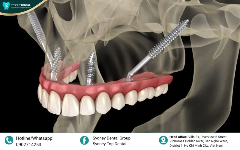 Zygomatic implants: A revolutionary solution for patients with extreme bone loss in the upper jaw.