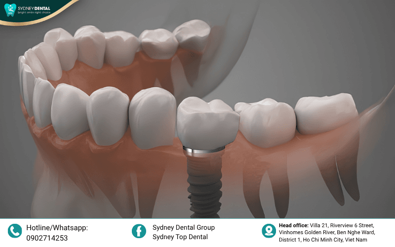 Choosing between premium and value-tier brands depends on your clinical needs and budget.