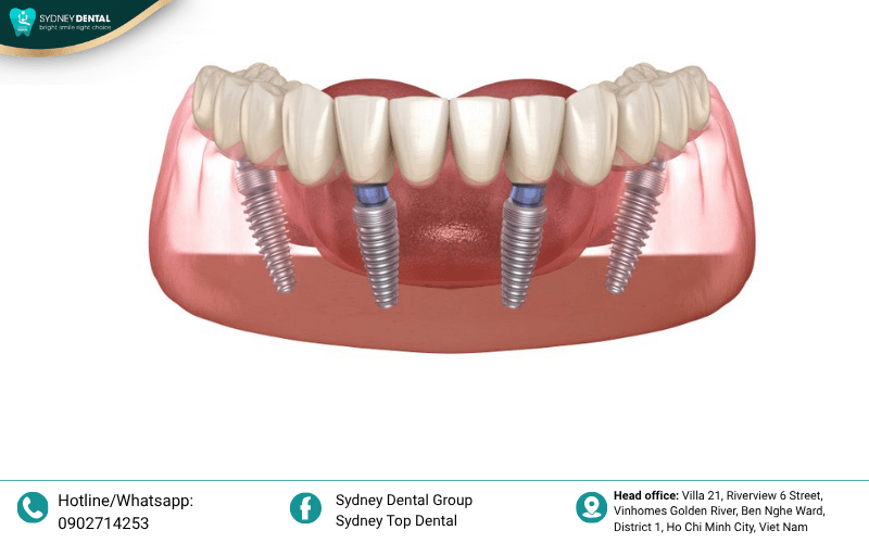 Bioactive surface technologies accelerate the healing process and ensure long-term stability