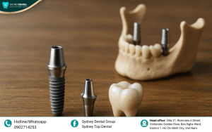 Dental Implant Costs in Vietnam: A Complete Guide 2026