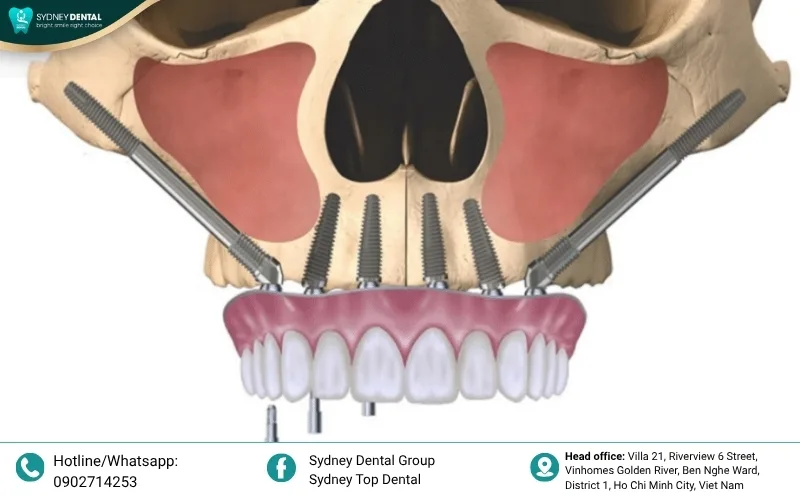 The complex trajectory of zygomatic implants and their proximity to vital facial structures