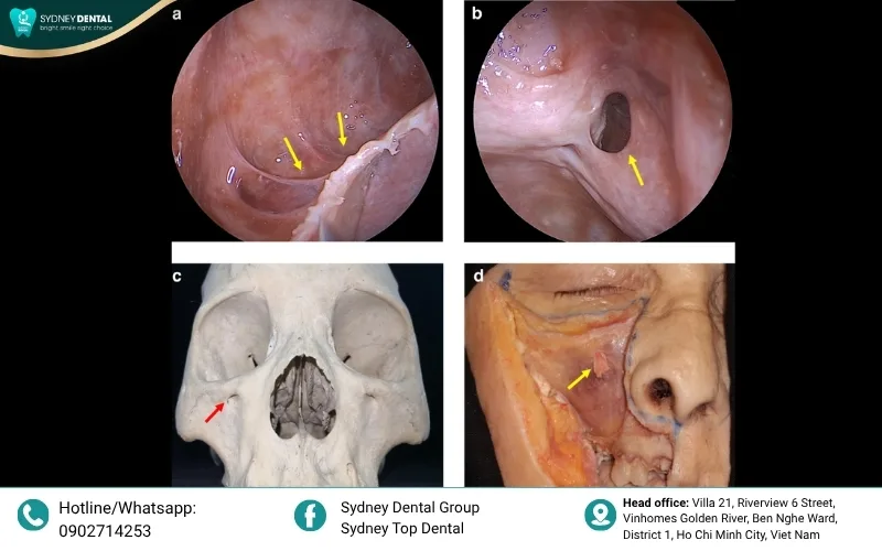 Proper management of the sinus membrane is essential to prevent maxillary sinusitis, the most frequent biological complication