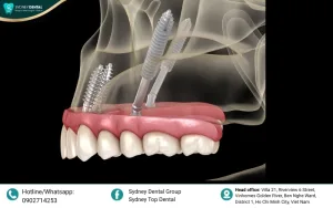 Zygomatic Dental Implants Complications: Scientific Truth and Effective Prevention