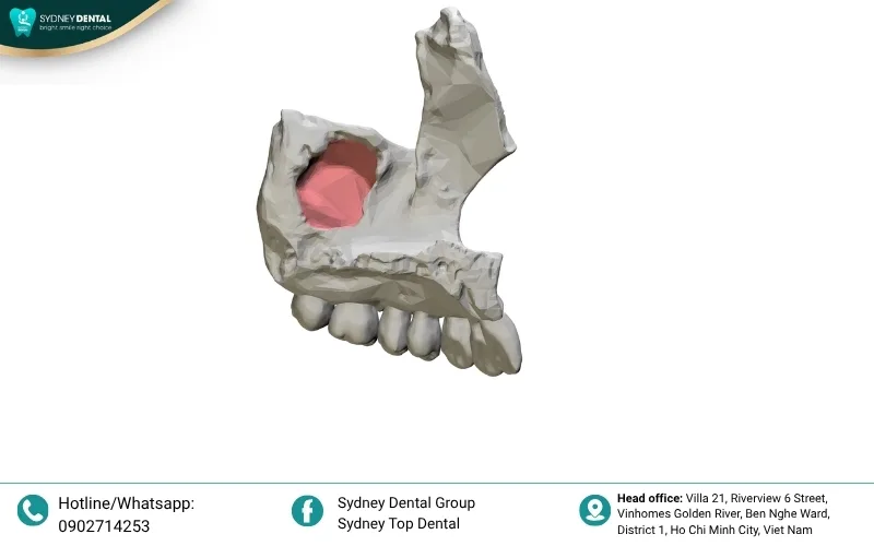 An oroantral fistula requires a hermetic surgical seal to prevent bacteria from entering the sinus cavity from the mouth