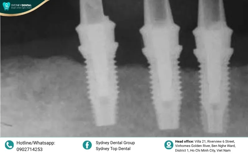 Annual X-rays allow clinicians to monitor crestal bone levels and intervene early if physiological remodeling leads to recession.