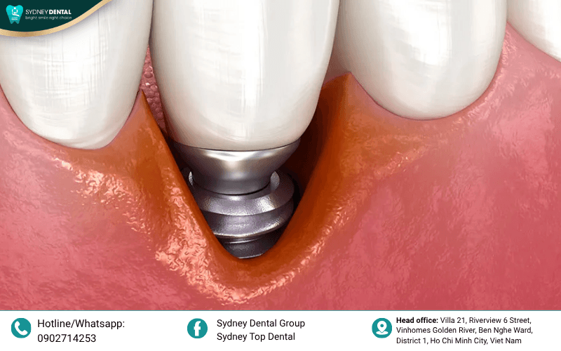 Recognizing early warning signs such as persistent swelling or odor can prevent a minor issue from becoming a total surgical failure.