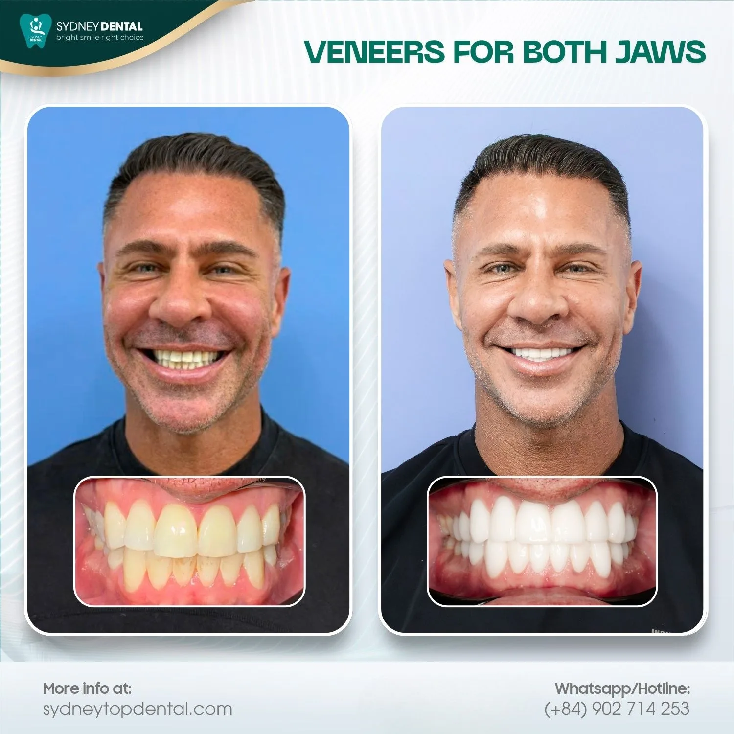 High-quality porcelain veneers instantly transform your smile, correcting chips, gaps, and discoloration.