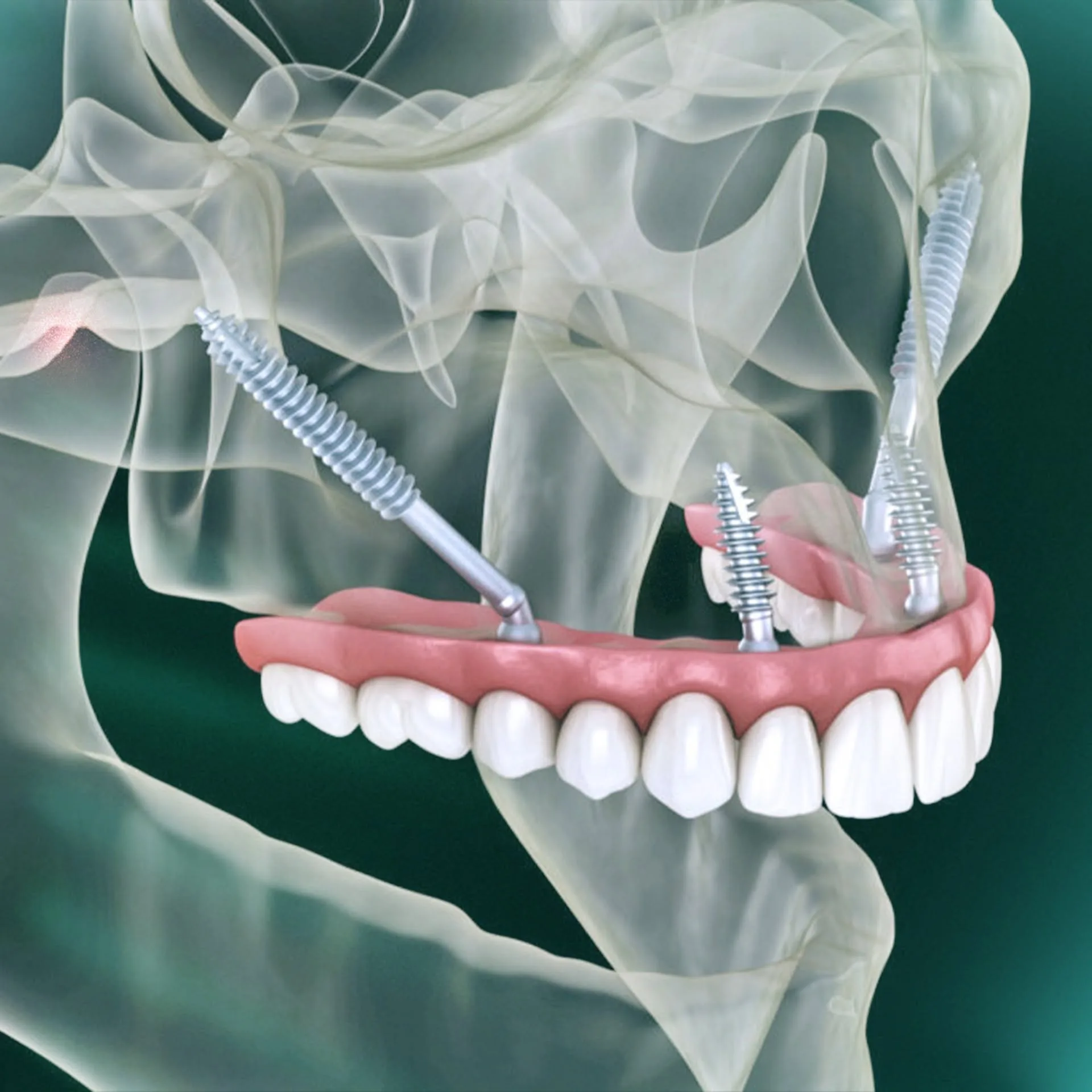 A solution for severe bone loss: The X-ray shows Zygomatic implants securely anchored into the cheekbone, providing a stable foundation where traditional implants could not