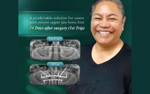 Restoring Hope When "There Isn't Enough Bone": Tutai’s Zygomatic Implant Success Story