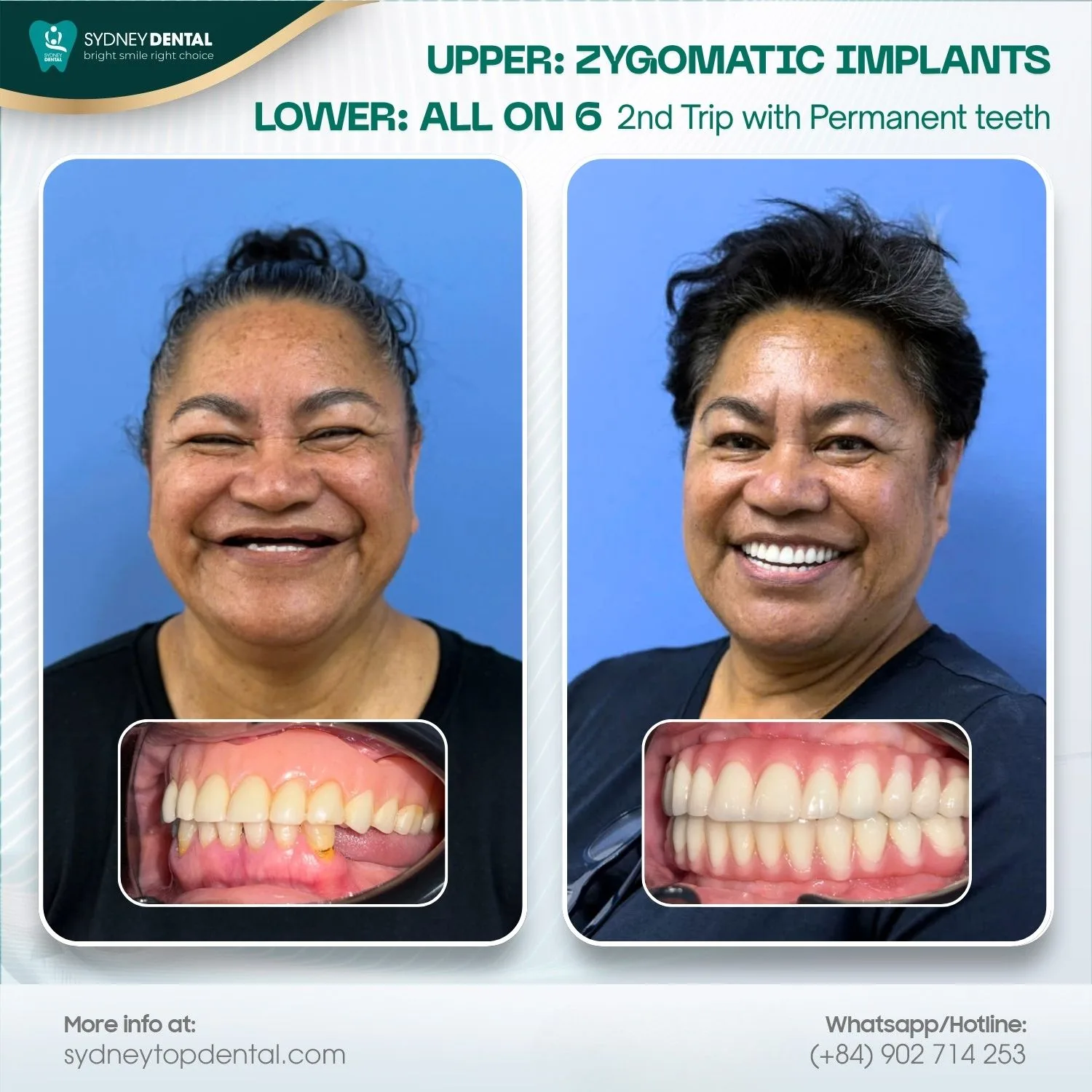 The primary advantage of zygomatic implants is the elimination of invasive bone grafting and faster recovery time.
