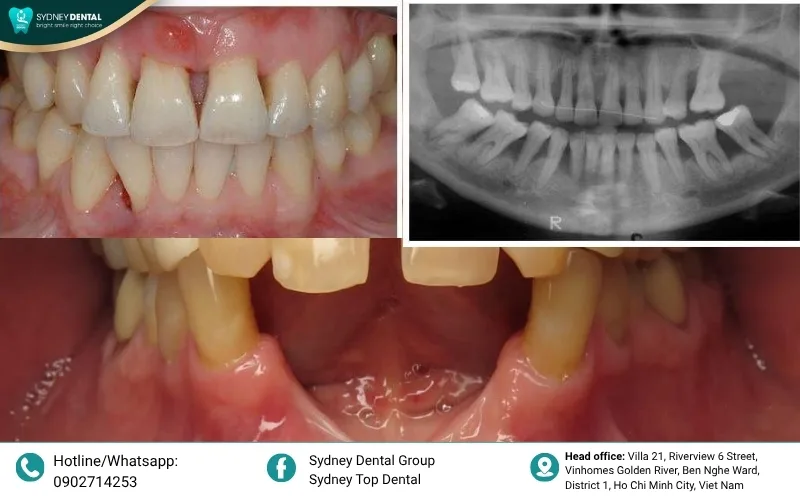 Illustration of how the jawbone shrinks and loses density after tooth loss