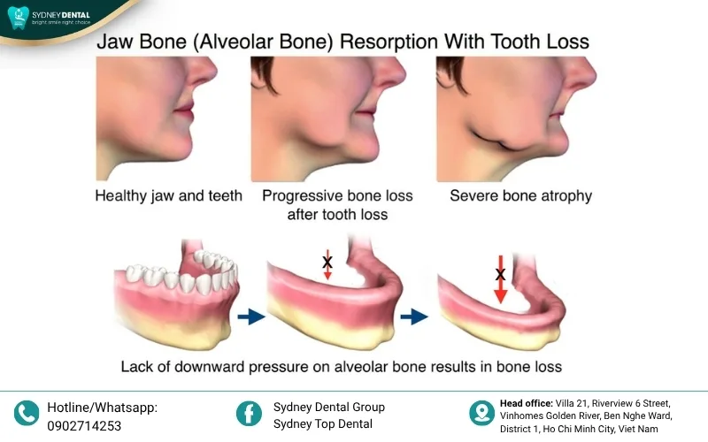 Visible gum recession and root exposure caused by underlying bone resorption