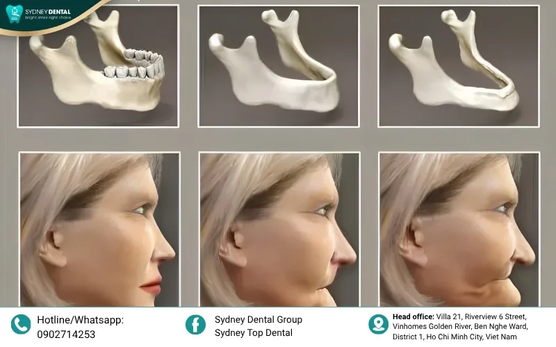 The "sunken look" and premature aging effect resulting from significant jawbone loss