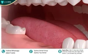 Dental Bone Loss: Before & After Images and the Essential Truths You Must Know