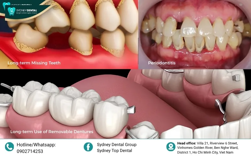 Periodontitis is a leading cause of the irreversible destruction of the alveolar bone.