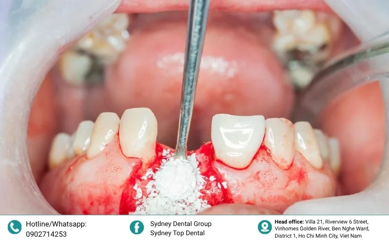 Bone grafting provides a scaffold for the body to regenerate lost jawbone volume.