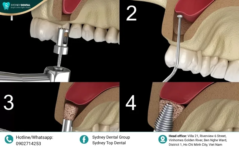 A sinus lift creates a stable foundation for implants in the upper posterior region