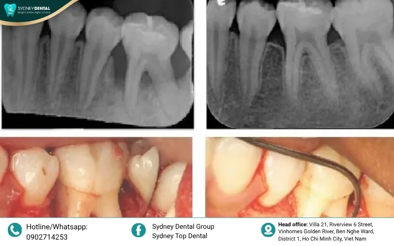 Dental plaque and tartar are the primary breeding grounds for bacteria that destroy the jawbone