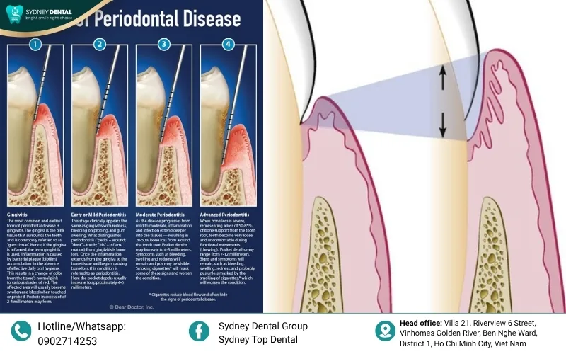 Periodontal pockets act as hidden reservoirs for bone-dissolving bacteria.