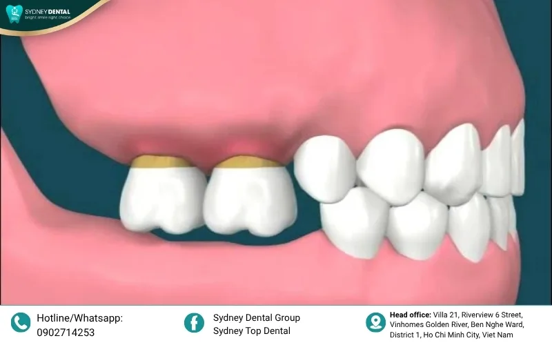 Receding gums and visible gaps are clear indicators that the underlying bone is deteriorating.