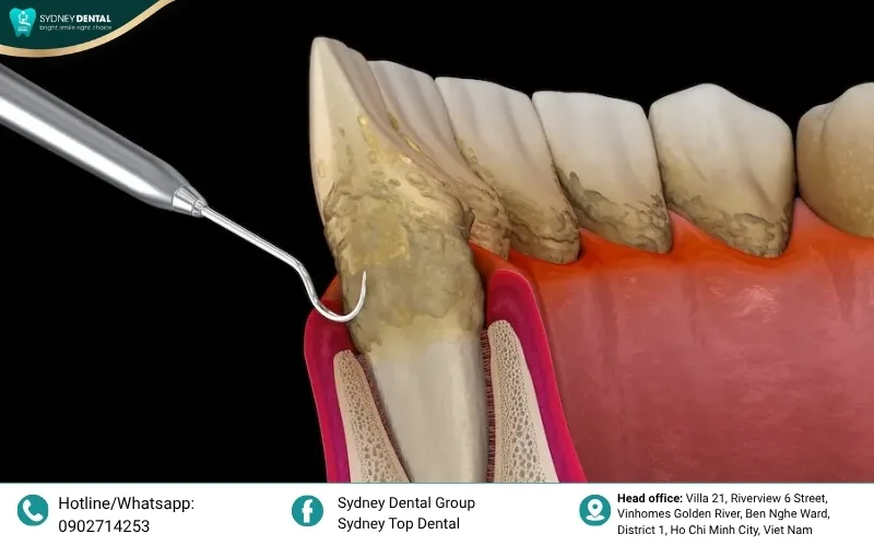 Scaling and root planing remove the source of infection to stop the bone-dissolving process