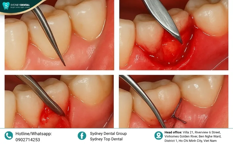 Surgery helps close deep pockets, making it easier to maintain oral health and protect the bone