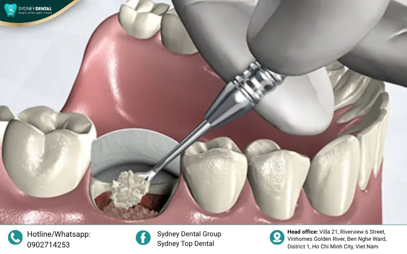 Surgery helps close deep pockets, making it easier to maintain oral health and protect the bone.