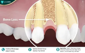 Dental Bone Loss And Teeth: Causes, Signs, and Effective Treatments