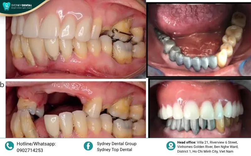 Receding gums are often the first visible sign that the underlying bone is dissolving