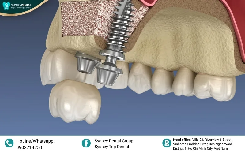 A sinus lift ensures there is enough bone height for safe implant placement in the molar area.