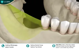 Bone loss causes a domino effect where neighboring teeth shift, lose support, and eventually fall out.