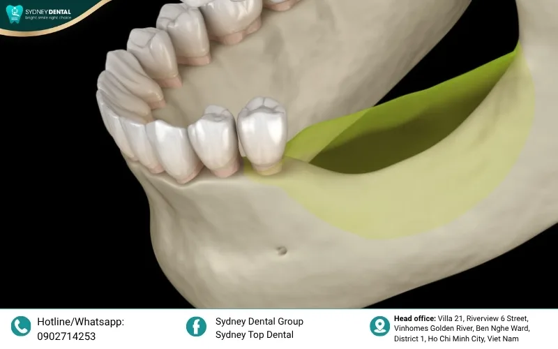 Facial collapse: How significant jawbone loss leads to sunken cheeks and deepened wrinkles.