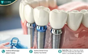 Dental Implants for Diabetics with Bone Loss: Solutions and Success Criteria