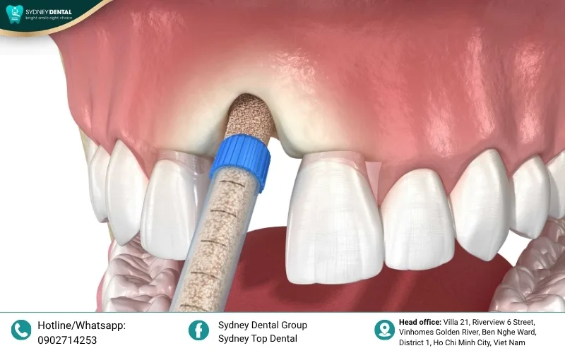 Bone grafting creates a solid foundation for implants in patients with significant bone depletion.