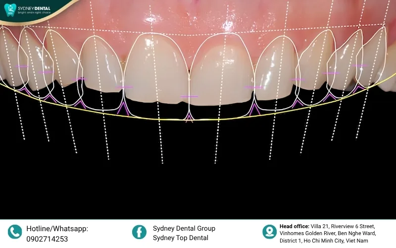 Digital Smile Design technology allows patients to preview their perfect smile before the procedure begins
