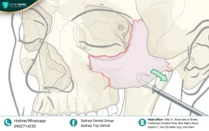 Zygomatic Fractures and Modern Dental Restoration Solutions