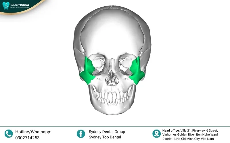 Conventional implants require adequate bone volume, which is often missing in patients with severe zygomatic-maxillary damage.
