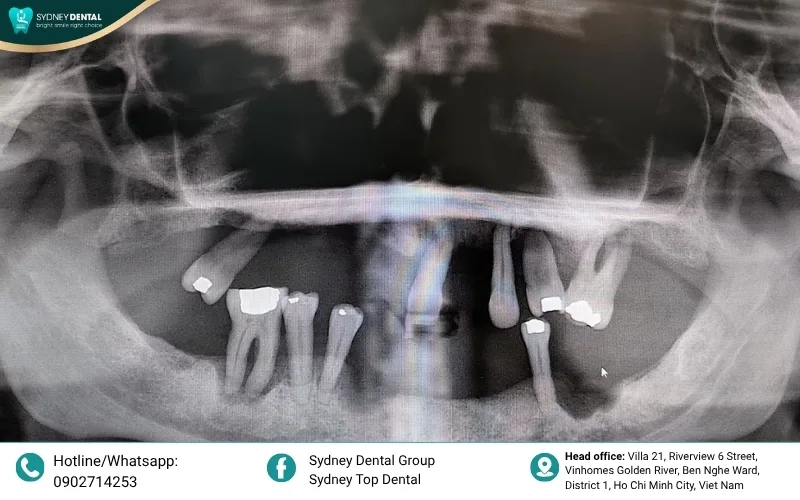 Progression of jawbone atrophy: From tooth loss to severe 90% bone volume reduction.