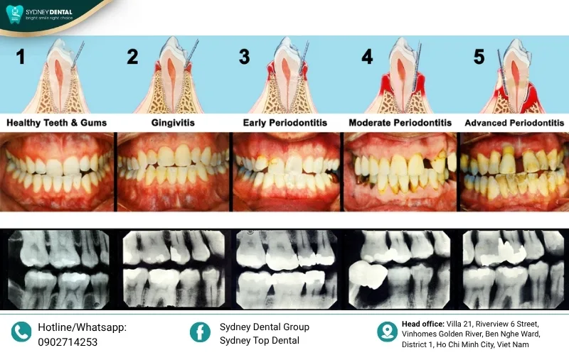 Facial aesthetic impact and the "domino effect" of loose adjacent teeth caused by severe bone loss.