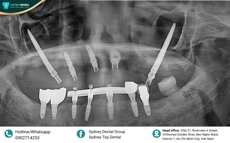 Restoring the foundation: Dental implants can be successfully placed even after significant bone regeneration.
