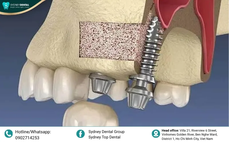 Sinus lift procedure: Safely lifting the sinus membrane to create space for bone grafting in the upper jaw.