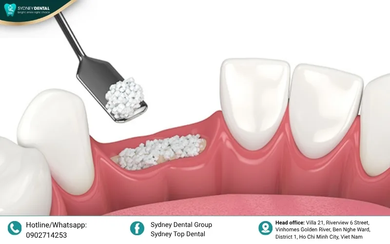 Synthetic bone graft: Using processed biocompatible materials as a supportive scaffold for natural bone regeneration.