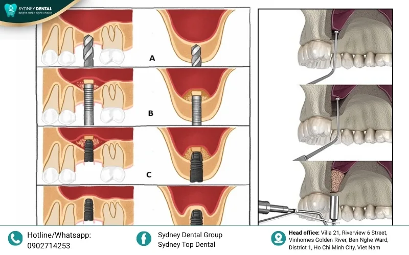 Collagen membrane: A protective barrier that guides bone growth and prevents soft tissue interference.