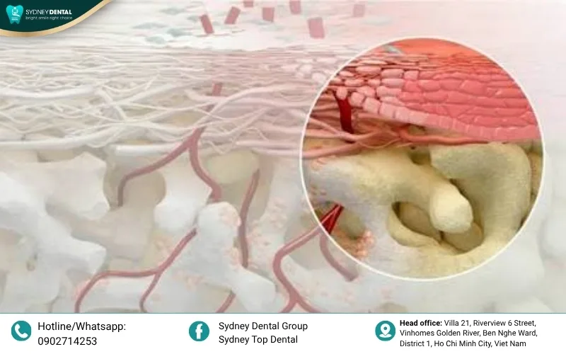 Collagen membrane: A protective barrier that guides bone growth and prevents soft tissue interference.