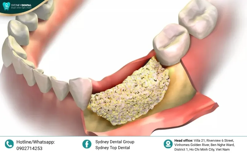 Autogenous bone graft: Utilizing your own bone to stimulate natural tissue regeneration.